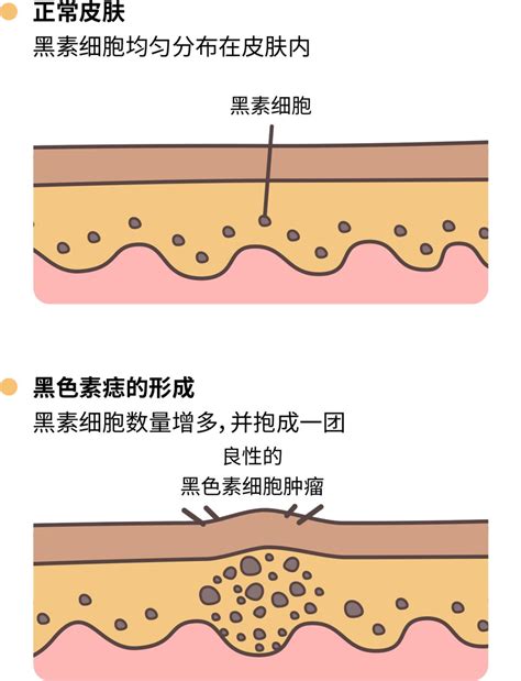 老二長痣|痣也可能会癌变！长在 3 个地方要注意